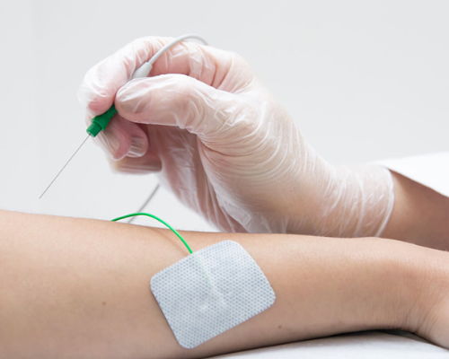 Eletroneuromiografia com Agulha – Bilateral